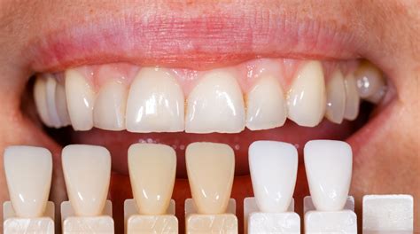 composite teeth veneers|Iba pa.